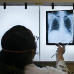 What you need to know about tuberculosis