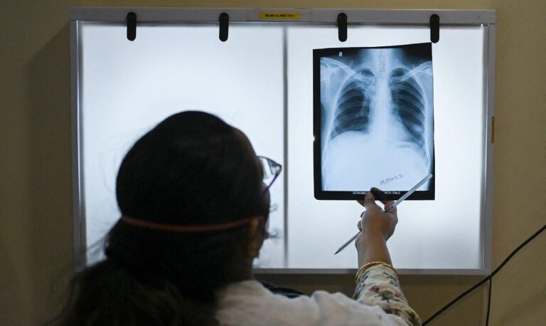 What you need to know about tuberculosis