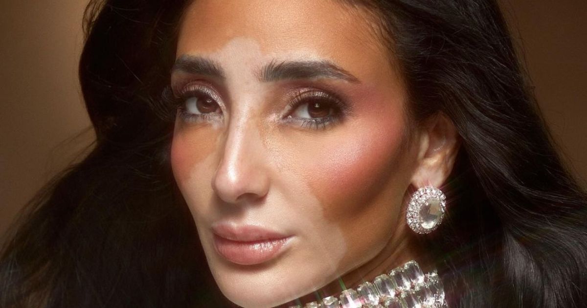 Logina Salah of Egypt proudly competes in Miss Universe 2024 despite skin condition