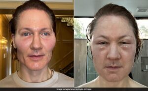 Tech Millionaire Bryan Johnson’s Face ‘Blows Up’ After Anti-Ageing Experiment Goes Wrong