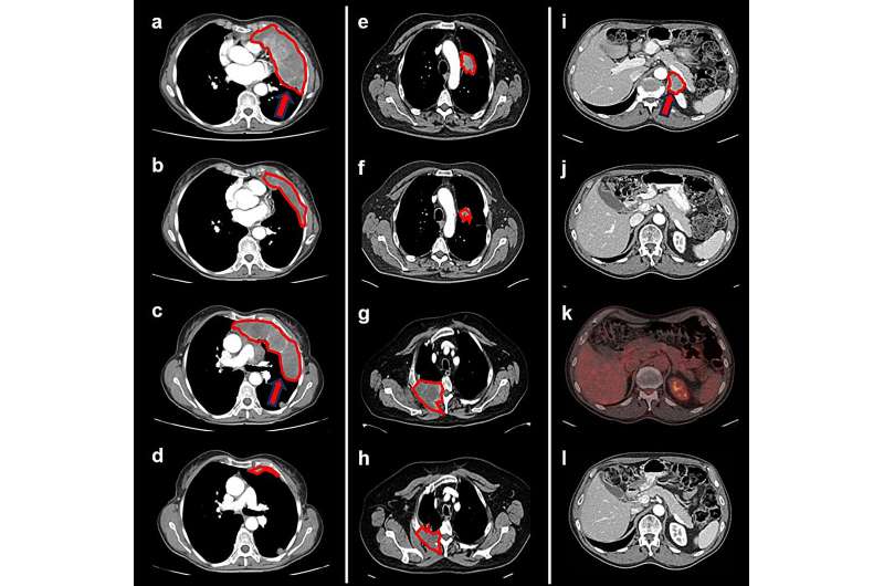 GDF-15 inhibitors show promise against refractory solid tumors in GDFATHER-1/2a clinical trial