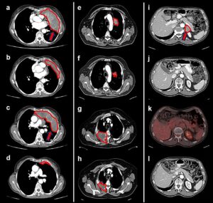 GDF-15 inhibitors show promise against hard-to-treat tumors in clinical trial