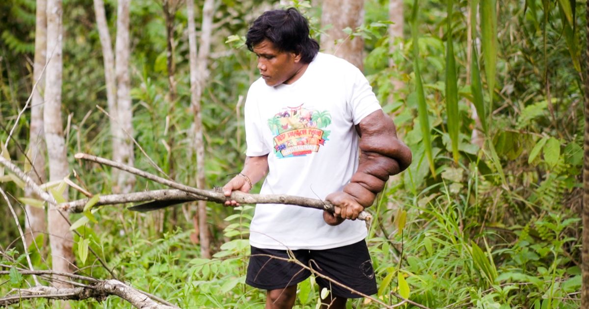 Man from Zamboanga del Sur suffers from unnaturally swollen arm