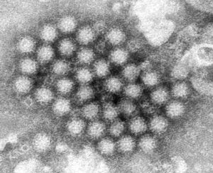 Norovirus cases surge in US, causing widespread stomach illness