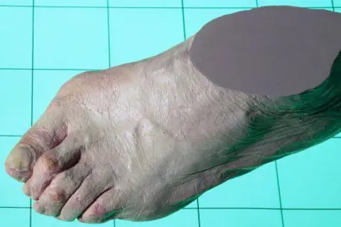 Getty Images Model of a bunioned foot