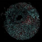 Researchers find potential link between nuclear speckles patterns and cancer treatment outcomes