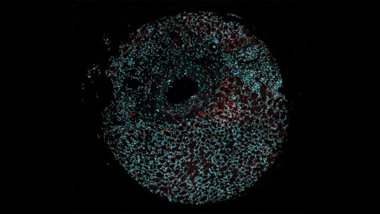 Researchers find potential link between nuclear speckles patterns and cancer treatment outcomes