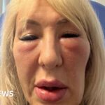 Botched fillers left Hull woman ‘looking like a gargoyle’