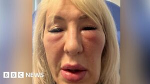 Botched fillers left Hull woman ‘looking like a gargoyle’