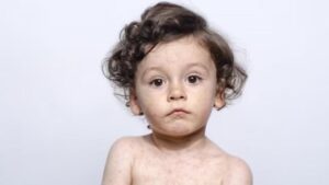 New Brunswick declares measles outbreak is over